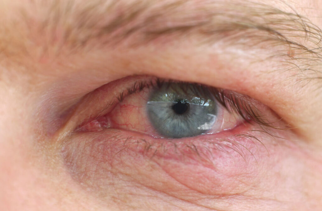A close-up of a human eye got an infection due to dried-out contact lenses.