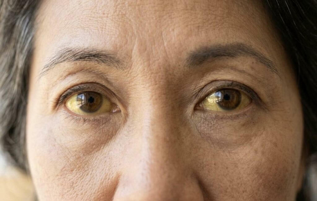 A close up of eyes that are a light shade of yellow where they should typically be white.